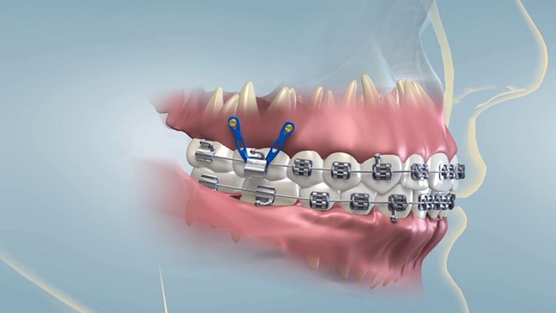Niềng răng bị mỏi hàm: Nguyên nhân và cách khắc phục nhanh nhất 3
