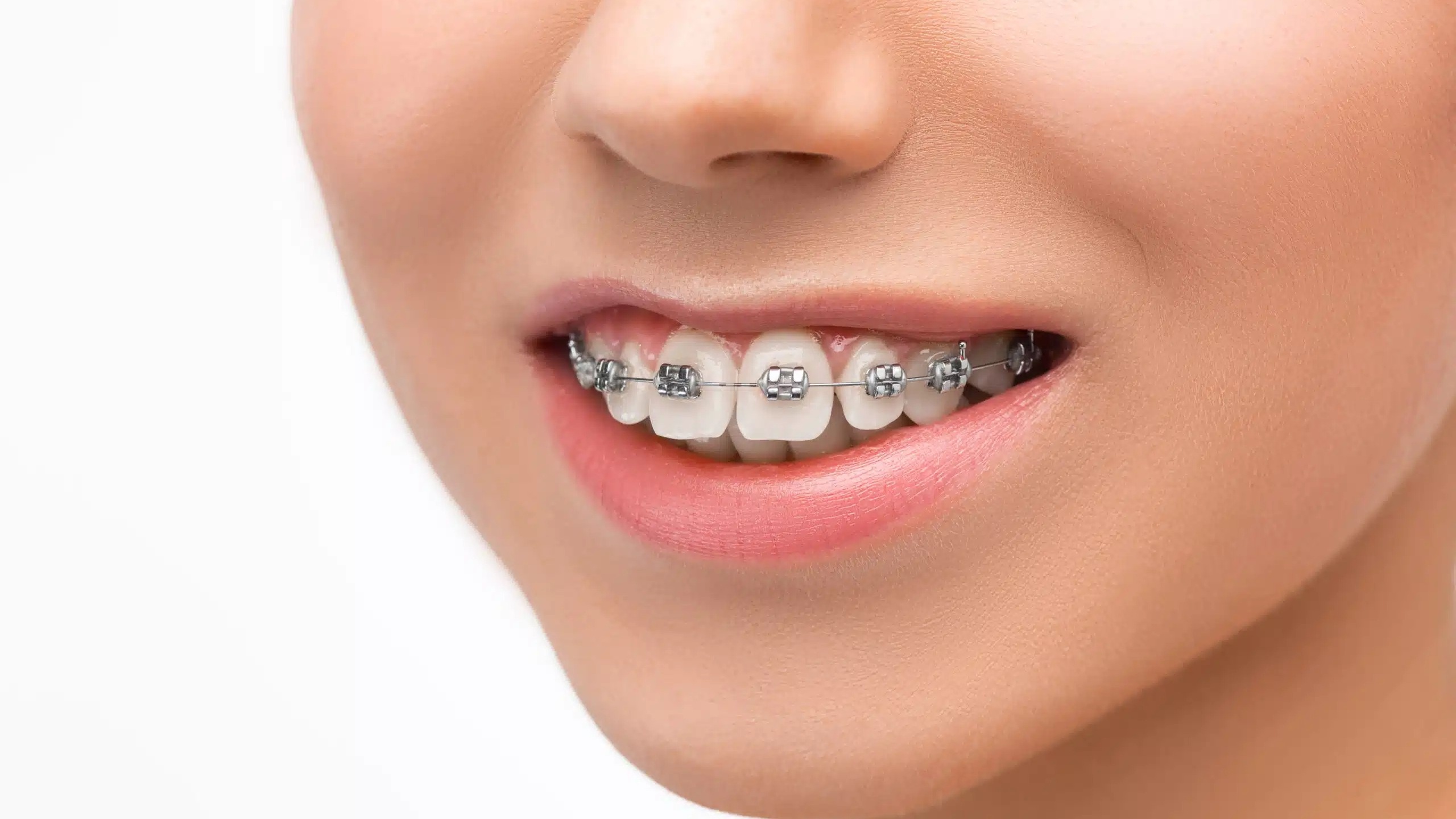 Niềng răng có hết móm không? Ưu điểm niềng răng khi trị móm