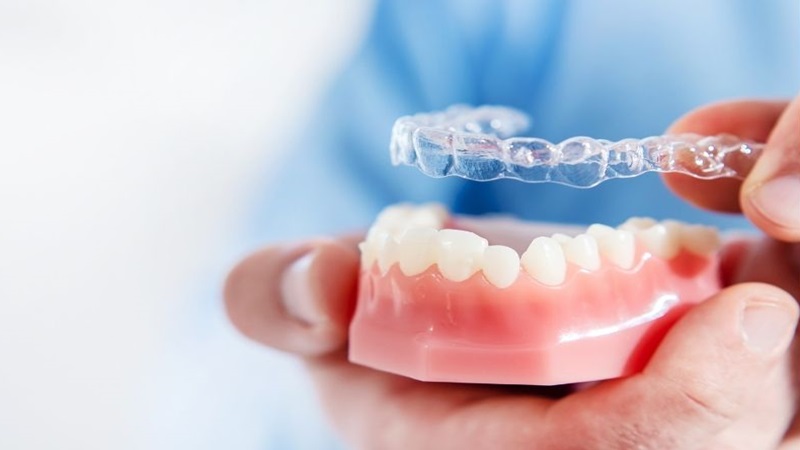 Niềng răng không mắc cài: Ưu điểm, hạn chế và một số lưu ý 1