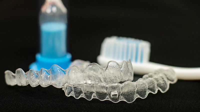 Niềng răng không mắc cài: Ưu điểm, hạn chế và một số lưu ý 4