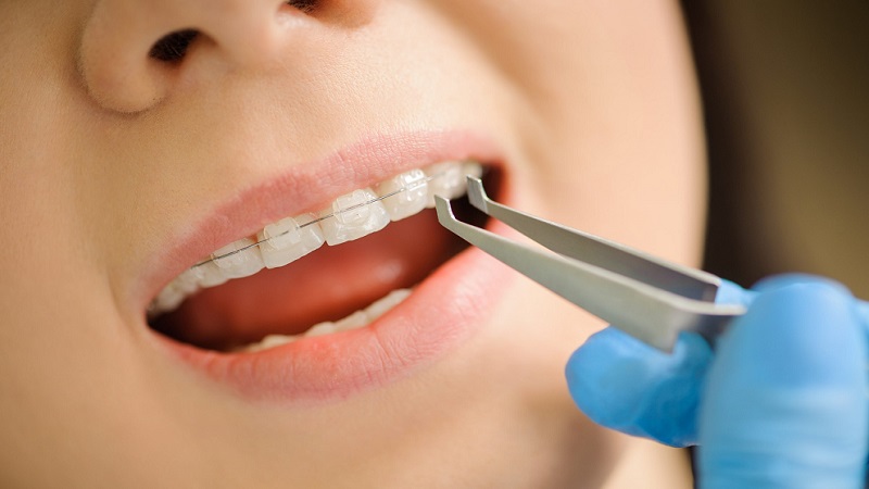 Niềng răng mắc cài sứ tự buộc: Ưu nhược điểm và báo giá chi tiết 4