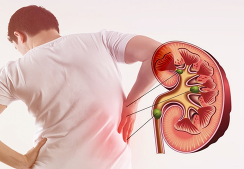 Cách nhận biết điểm đau niệu quản 2