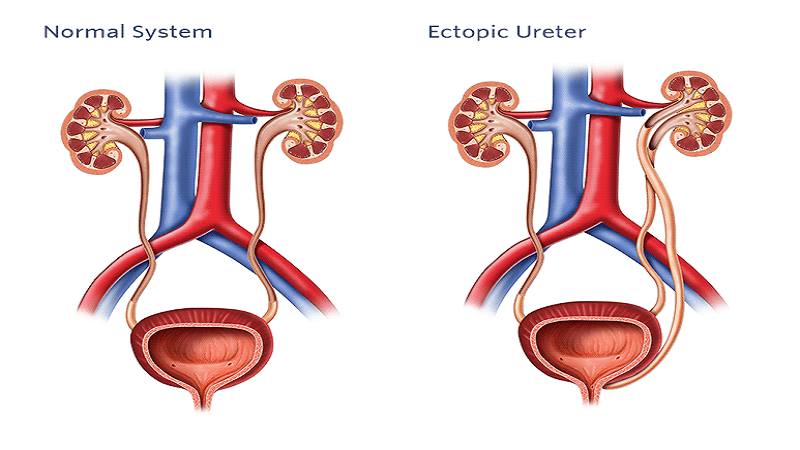 Niệu quản lạc chỗ và những thông tin hữu ích dành cho bạn 1