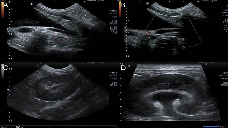 Niệu quản lạc chỗ và những thông tin hữu ích dành cho bạn 2
