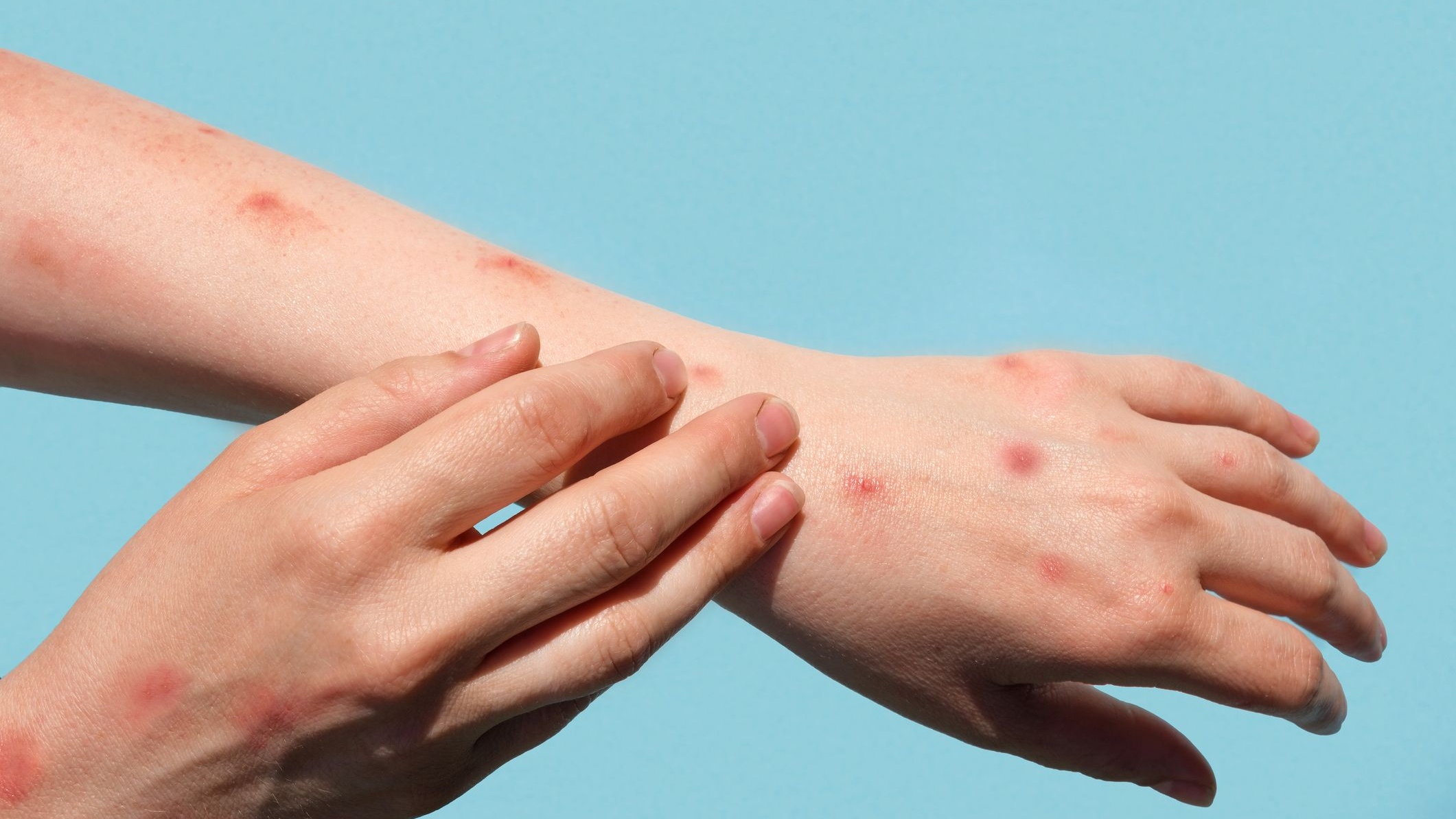Nổi mẩn đỏ ngứa như muỗi đốt: Nguyên nhân và cách xử lý