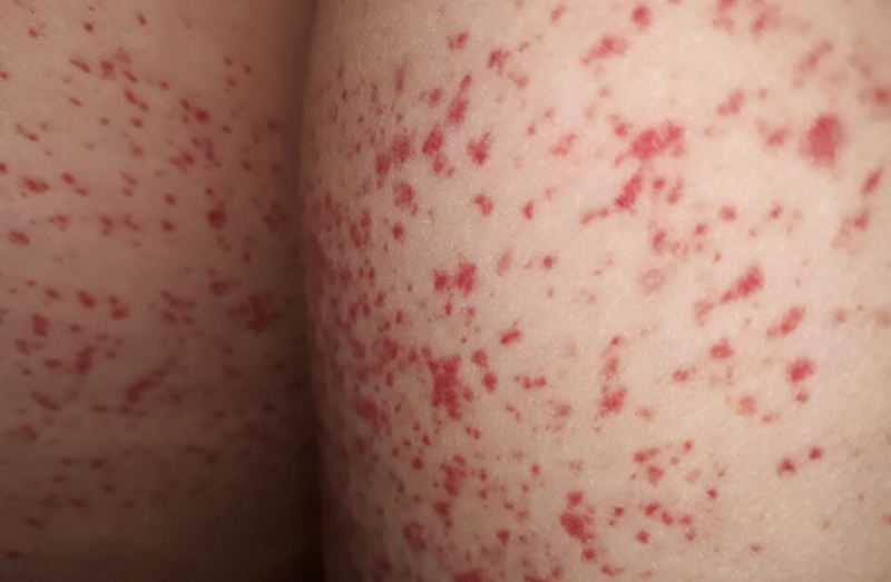 Nổi mẩn đỏ ở mông nhưng không ngứa là bị bệnh gì?  1