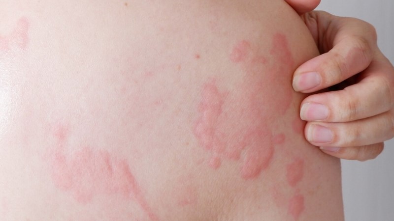 Nổi mề đay cấp tính: Khái niệm, dấu hiệu, nguyên nhân và cách xử trí 1