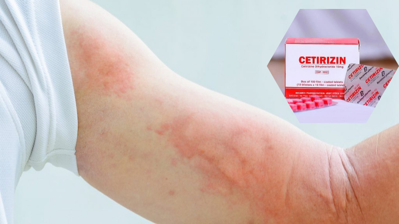 Nổi mề đay cấp tính: Khái niệm, dấu hiệu, nguyên nhân và cách xử trí 4