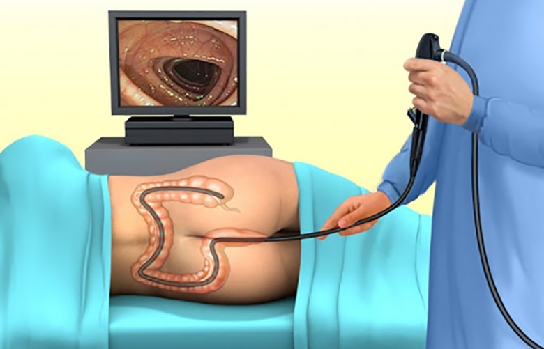Nội soi đại tràng ống mềm không sinh thiết và những điều cần biết 1