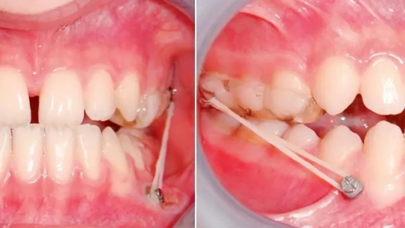 Nong hàm là gì? Khi nào cần thực hiện? 3