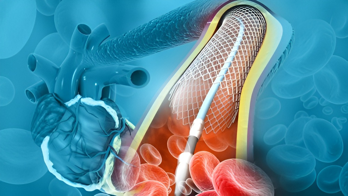 Thủ thuật nong mạch vành và đặt stent có an toàn hay không?