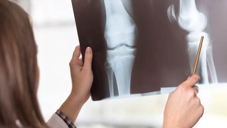 Nốt đặc xương là gì? Nguyên nhân, triệu chứng, chữa trị và phòng ngừa 1