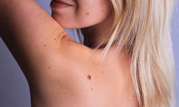 Nốt ruồi bị ngứa là dấu hiệu gì về sức khỏe? 3