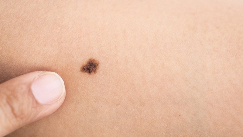 Nốt ruồi có di truyền không? Cách nhận biết nốt ruồi lành tính và ác tính 1