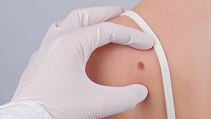 Nốt ruồi có di truyền không? Cách nhận biết nốt ruồi lành tính và ác tính 2