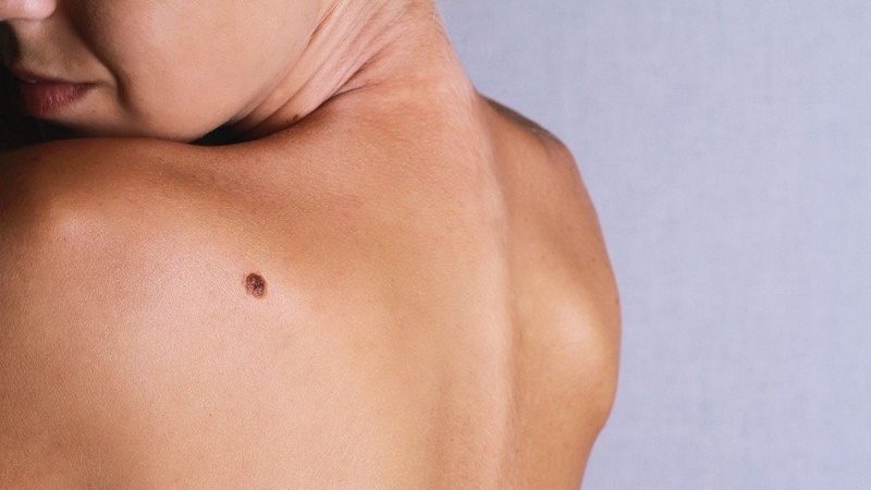 Nốt ruồi hình thành thế nào? Nguyên nhân và cách phân loại 1