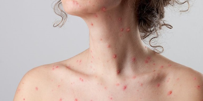 Nốt thủy đậu bị nhiễm trùng có nguy hiểm không? 2