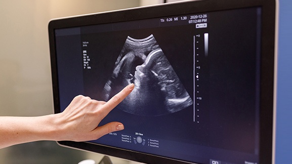 Siêu âm đo tình trạng lượng nước ối trung bình 2