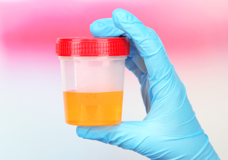 Nước tiểu màu vàng chanh​ có bình thường không? 1