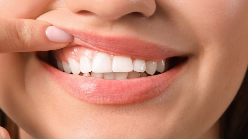 Nướu răng bị trắng: Những nguyên nhân chính và giải pháp can thiệp 1