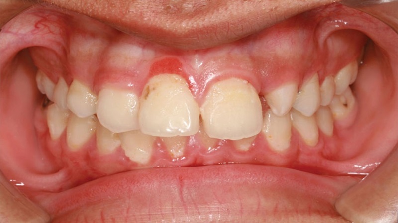 Nướu răng bị trắng: Những nguyên nhân chính và giải pháp can thiệp 3