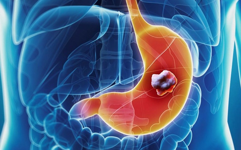 phac-do-dieu-tri-loet-da-day-ta-trang 1.jpg