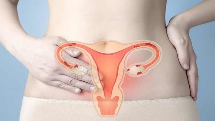 Đối tượng mắc bệnh và phác đồ điều trị tăng sinh nội mạc tử cung 2