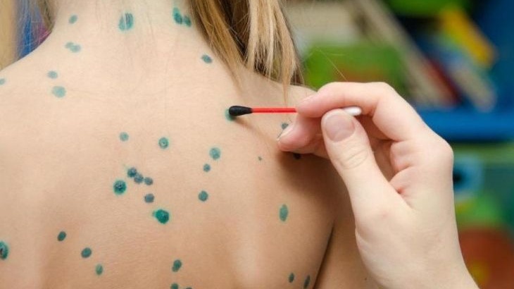 Phác đồ điều trị thủy đậu ở trẻ em bố mẹ cần biết 2