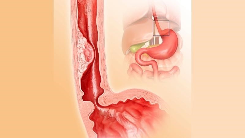 Phác đồ điều trị trào ngược dạ dày thực quản mới nhất hiện nay 2
