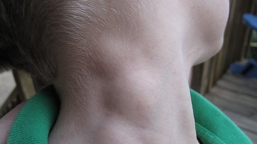 Phác đồ điều trị u lympho không hodgkin như thế nào? 1