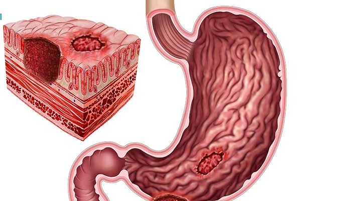 Phác đồ điều trị viêm dạ dày như thế nào? 1