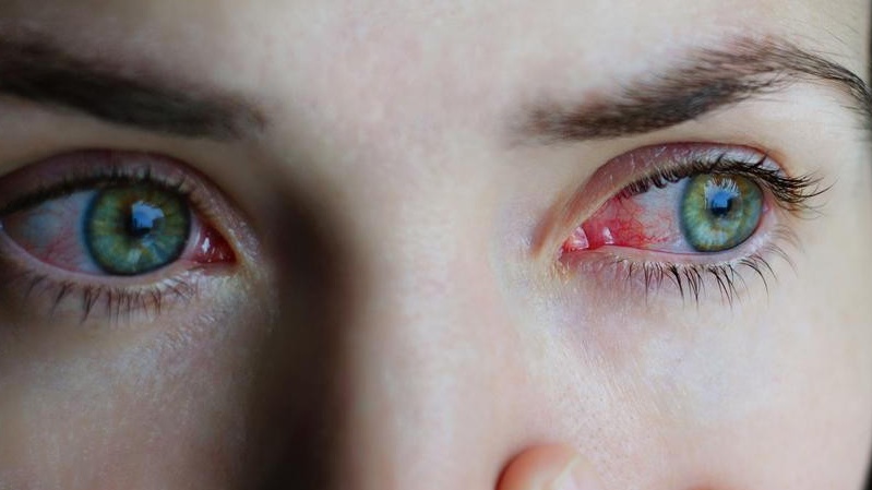 Phác đồ điều trị viêm kết mạc Bộ Y tế 1