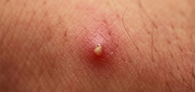 Phải làm sao khi mông bị nổi mụn đỏ? 2