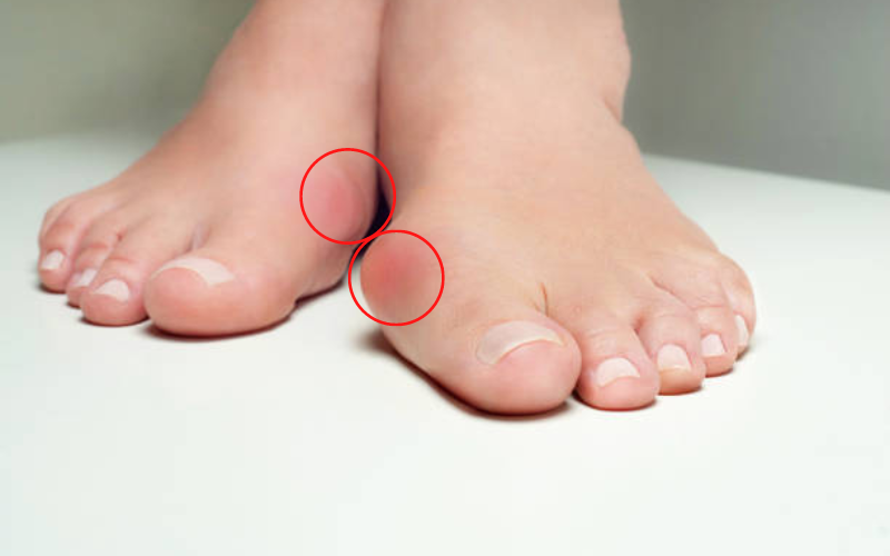 Phân biệt bệnh gout và giả gout 2