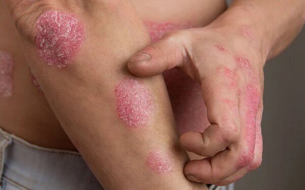 phan-biet-benh-viem-khop-dang-thap-va-viem-khop-vay-nen 2.jpg