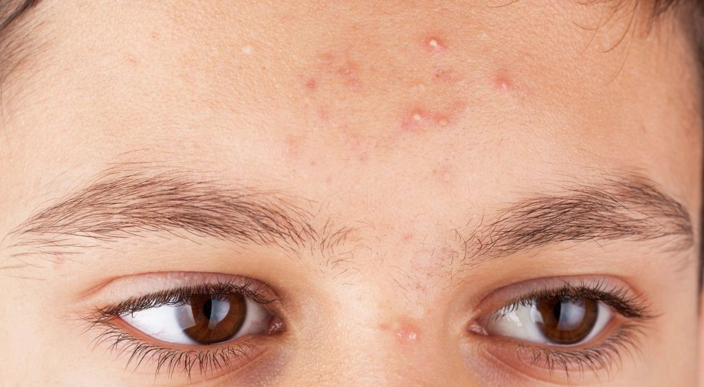Giải đáp mụn tuổi dậy thì có tự hết không?