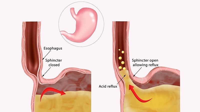 Phân biệt ợ chua, trào ngược axit và GERD như thế nào? 2
