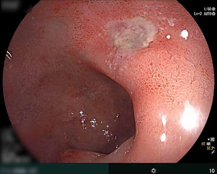 Phân độ Forrest ở những bệnh nhân loét dạ dày tá tràng 4