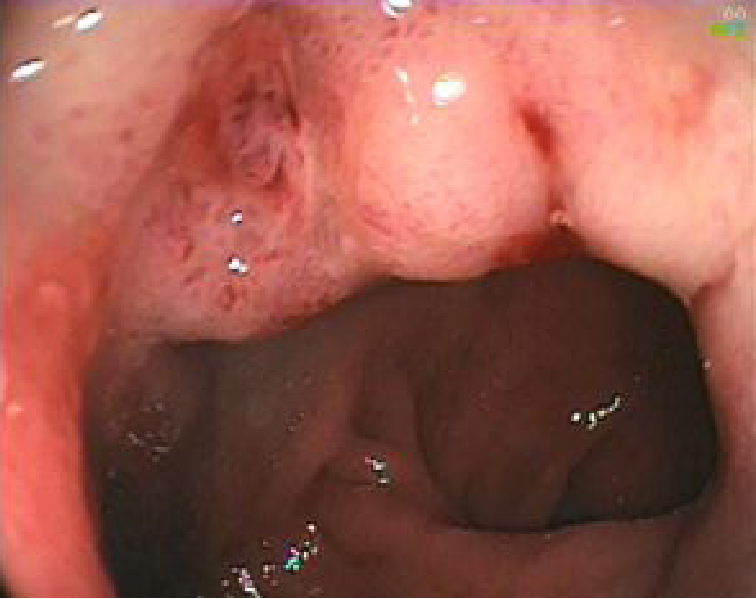 Phân độ Forrest ở những bệnh nhân loét dạ dày tá tràng 2