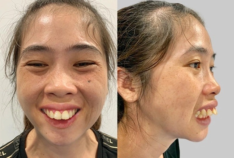 Quy trình phẫu thuật chỉnh hàm hô 1