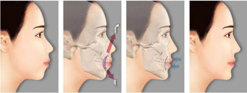 Phẫu thuật hàm hô bao lâu thì lành? Những lưu ý sau khi thực hiện? 2