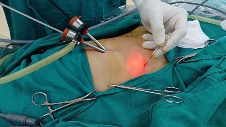 phau-thuat-mo-soi-mat-co-nguy-hiem-khong 2.jpg