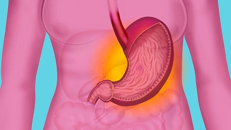 Phẫu thuật nội soi cắt 3/4 dạ dày và những điều cần biết 1