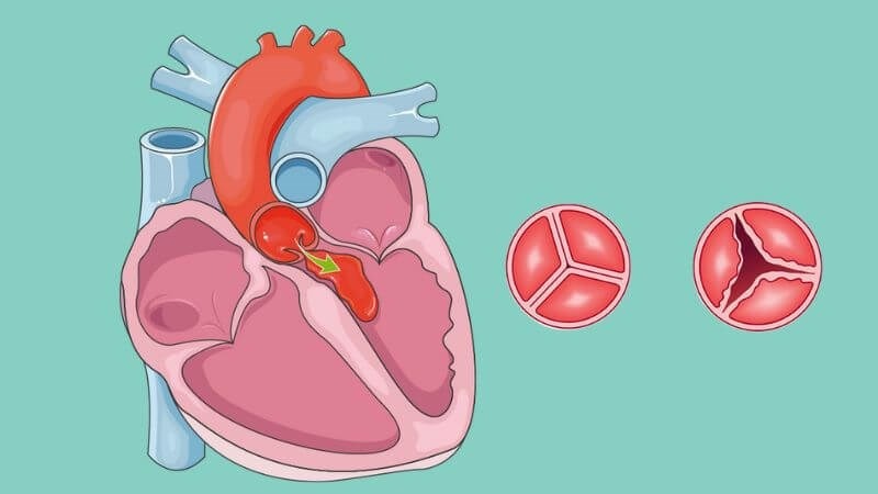 phau-thuat-ross-o-benh-van-dong-mach-chu 1.jpg