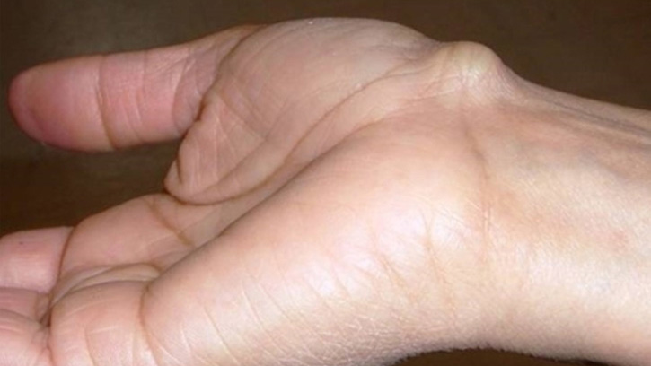 Phẫu thuật thay toàn bộ xương cánh tay áp dụng điều trị bệnh gì? Ưu và nhược điểm của phương pháp này 2