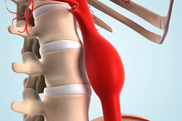 phinh-dong-mach-chu-nguc-nguy-hiem-nhu-the-nao 1.jpg