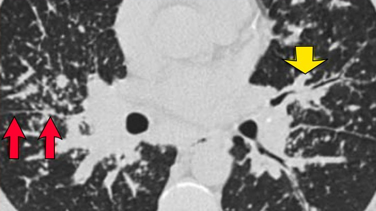 phuong-phap-chan-doan-hinh-anh-hrct-la-gi 1.jpg