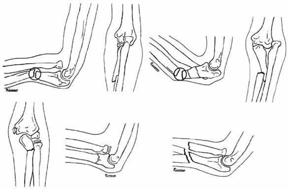 phuong-phap-dieu-tri-hay-monteggia-hieu-qua 2.jpg