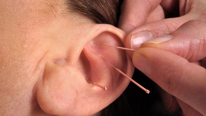 Phương pháp nhĩ châm là gì? Liệu trình chữa trị như thế nào? 1
