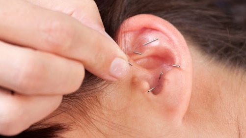 Phương pháp nhĩ châm là gì? Liệu trình chữa trị như thế nào? 2